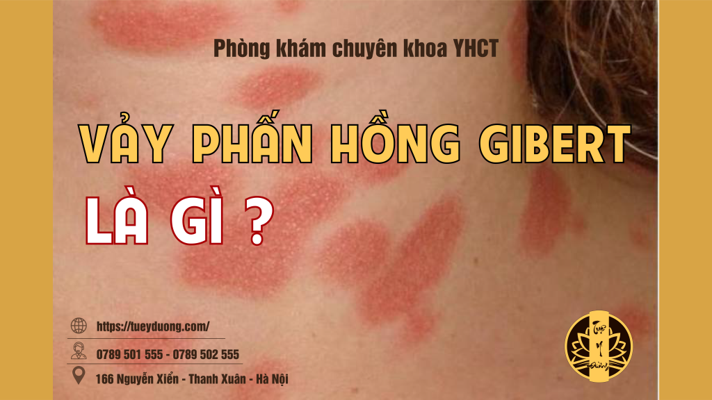 Vảy Phấn Hồng Gibert Là Bệnh Gì Tuệ Y Đường 0317