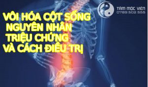 Vôi hóa cột sống: nguyên nhân, triệu chứng và cách điều trị.