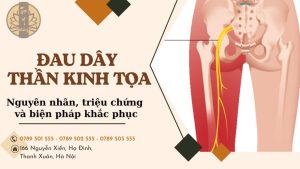 Đau dây thần kinh tọa