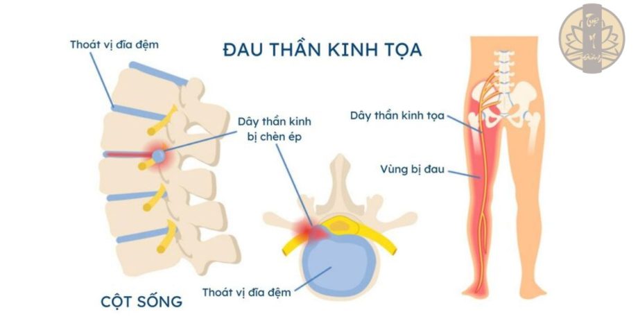 Đau dây thần kinh tọa 