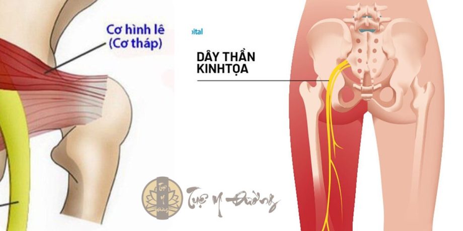 Phân biệt đau dây thần kinh tọa với cơ hình lê