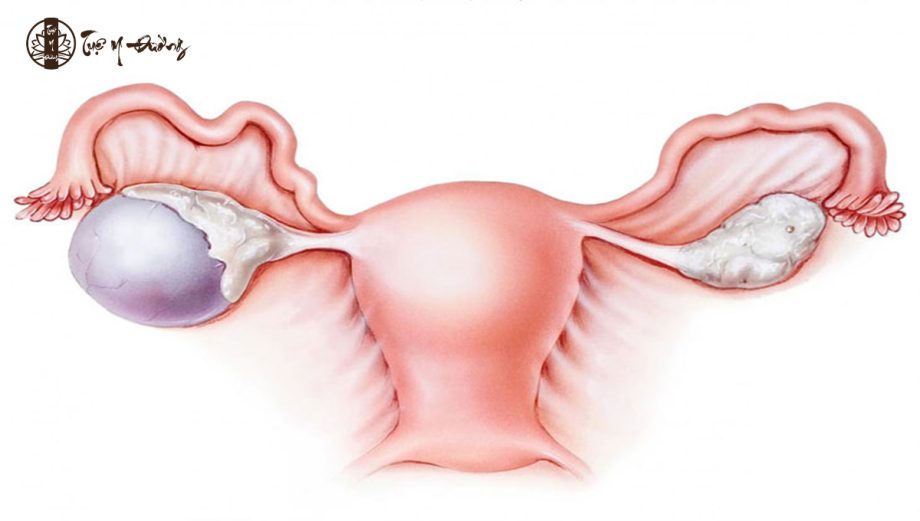U nang buồng trứng là nguyên nhân gây giảm progesterone