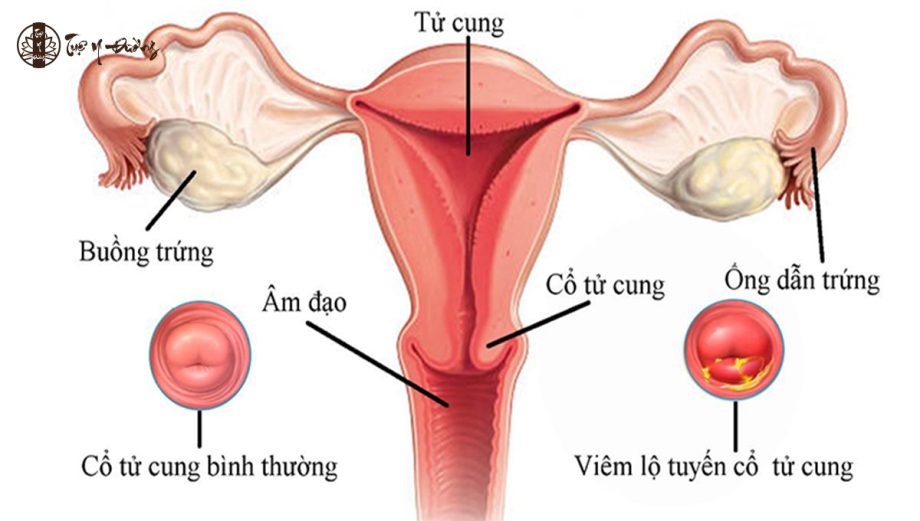 Viêm lộ tuyến cổ tử cung là tình trạng các tế bào tuyến ở trong phát triển lan ra phía ngoài cổ tử cung.