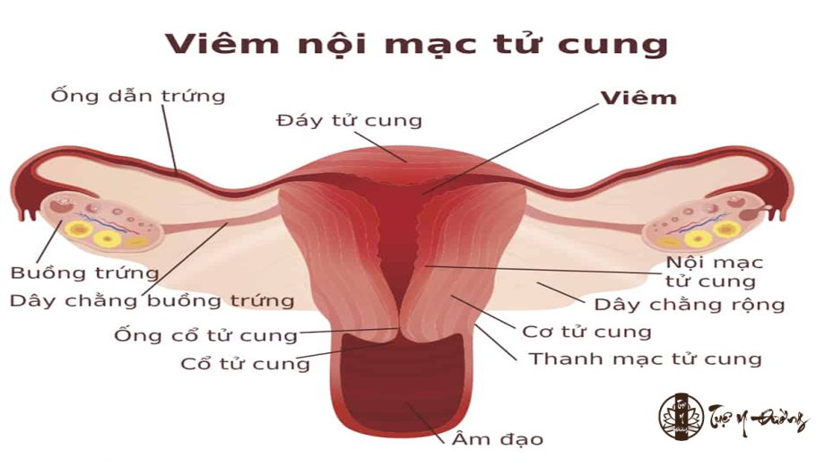 Bệnh viêm nội mạc tử cung là bệnh lý nhiễm trùng ở vùng niêm mạc cổ tử cung.