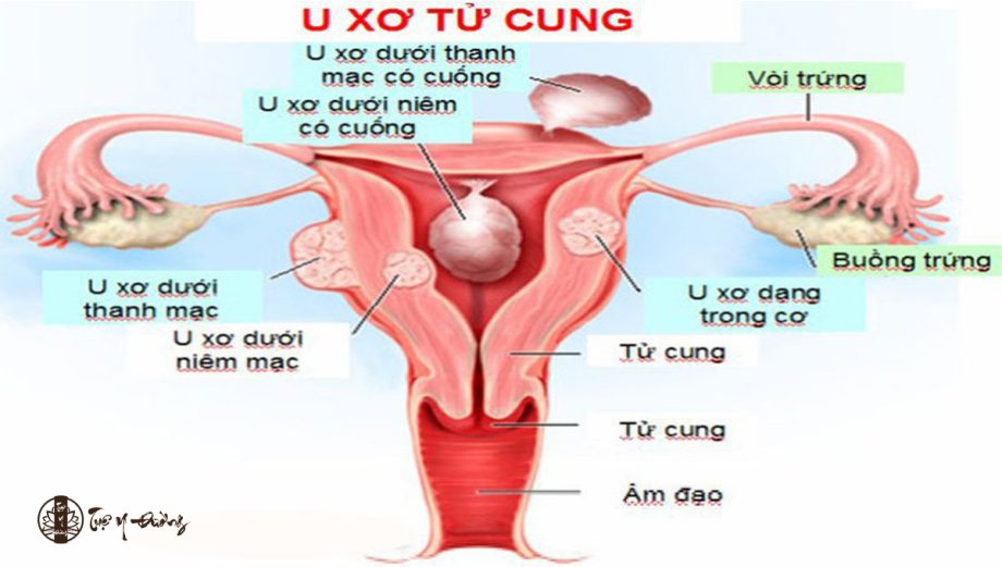 U xơ tử cung thường được phát hiện khi đi khám bệnh định kỳ
