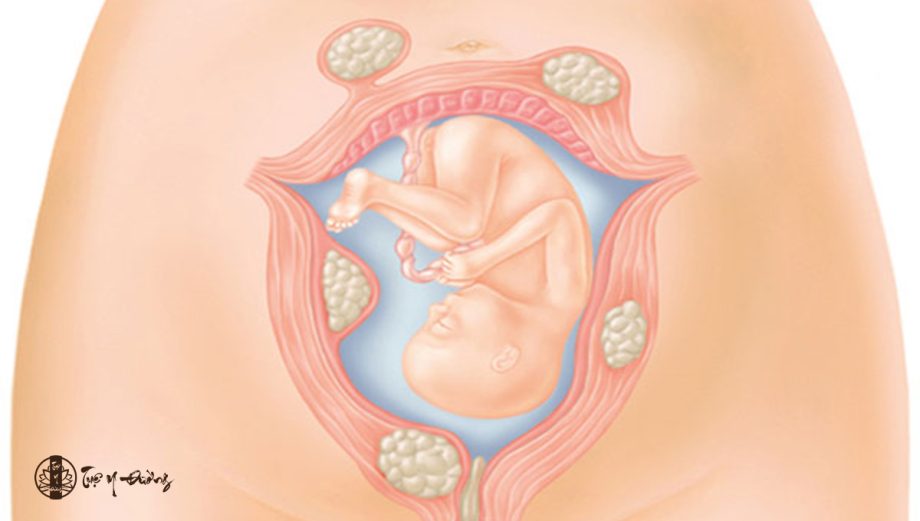 U xơ tử cung khi mang thai sẽ ảnh hưởng lớn đến sức khoẻ của mẹ và bé