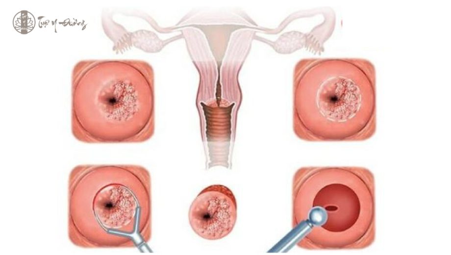 Hình ảnh Viêm lộ tuyến cổ tử cung