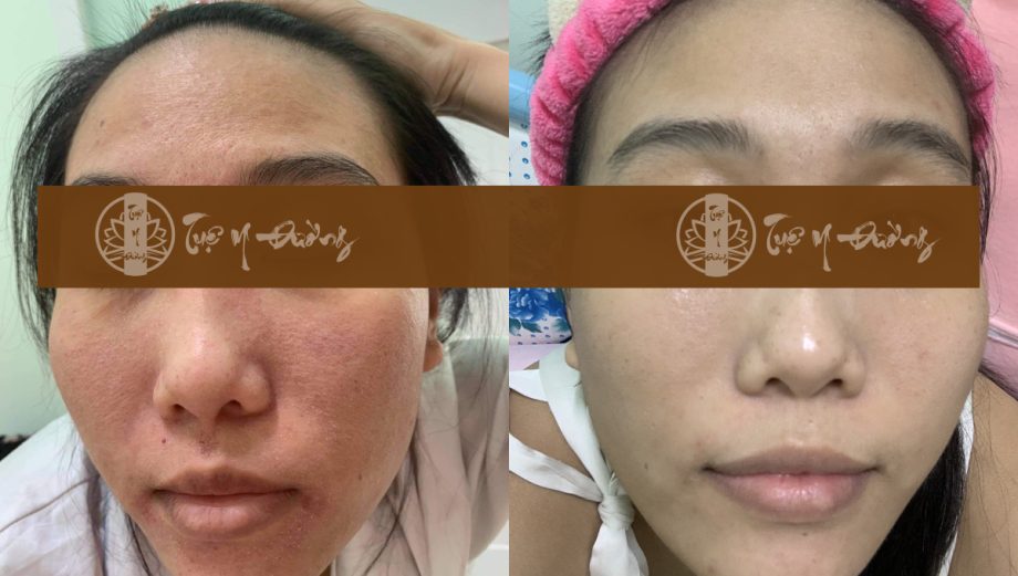 Hình ảnh da mặt bệnh nhân trước và sau điều trị