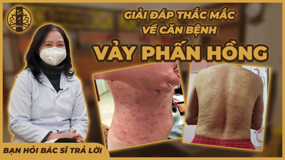 VẢY PHẤN HỒNG