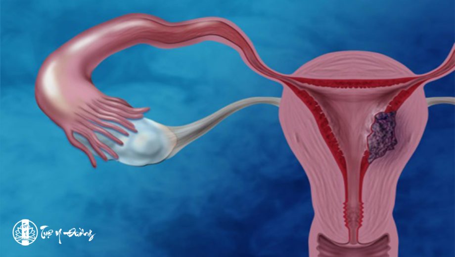 U nang buồng trứng là tình trạng tử cung xuất hiện một hay nhiều khối u