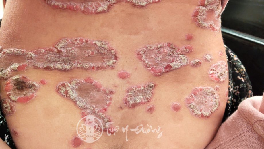 Bệnh vảy nến thường biểu hiện với các mảng da tổn thương phân bố đối xứng, màu đỏ
