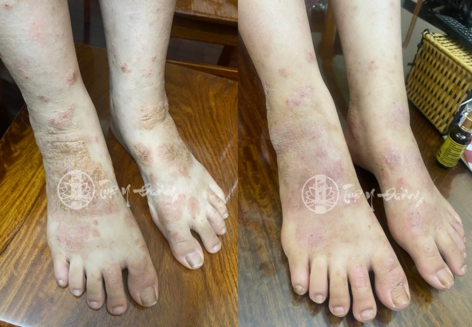 Tình trạng da ở chân sau gần 2 tuần dùng thuốc