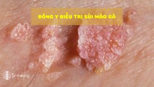 Đông y điều trị sùi mào gà