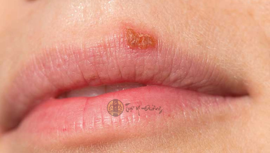 Herpes môi là một bệnh lây nhiễm