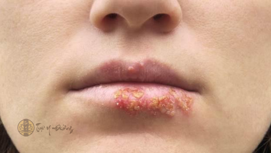 Hình ảnh tổn thương trong bệnh Herpes môi