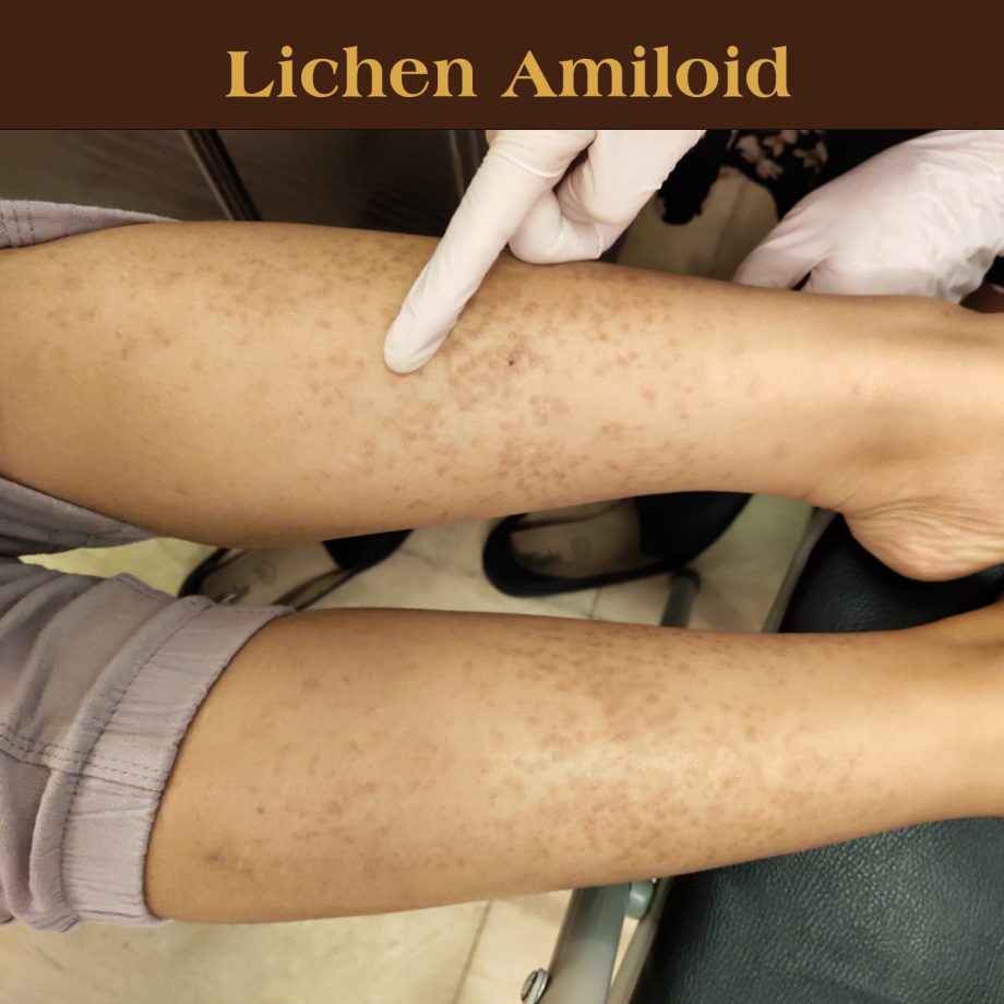điều trị Lichen amiloid