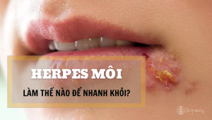 Herpes môi điều trị như nào