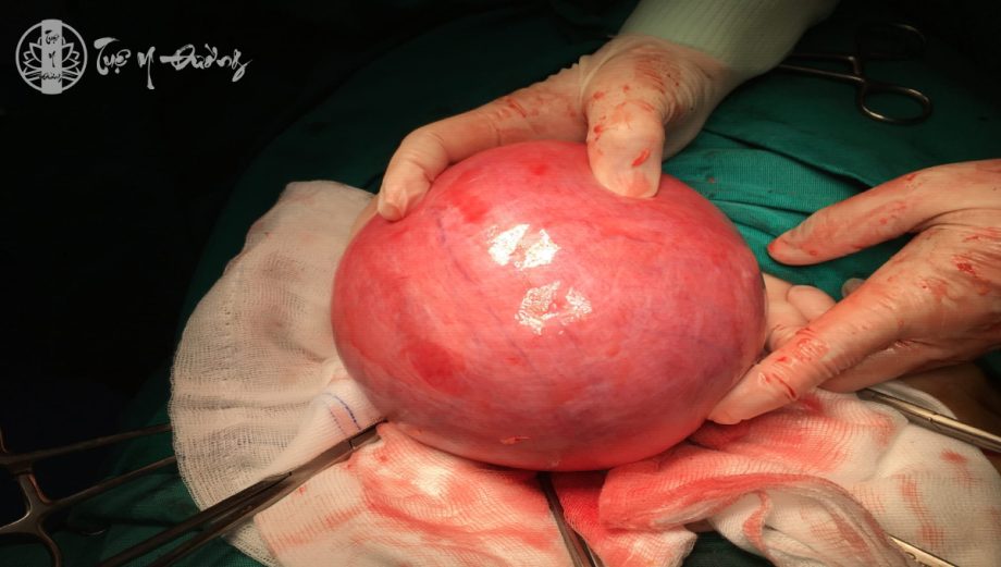 Phẫu thuật bóc tách khối u xơ tử cung trên 1kg