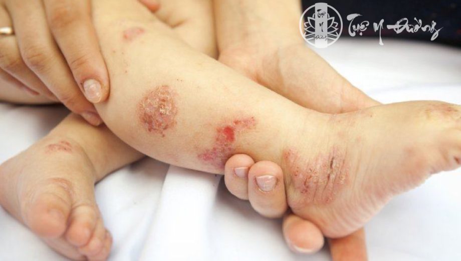 Triệu chứng điển hình của bệnh là các thương tổn da khô kèm theo ngứa. 