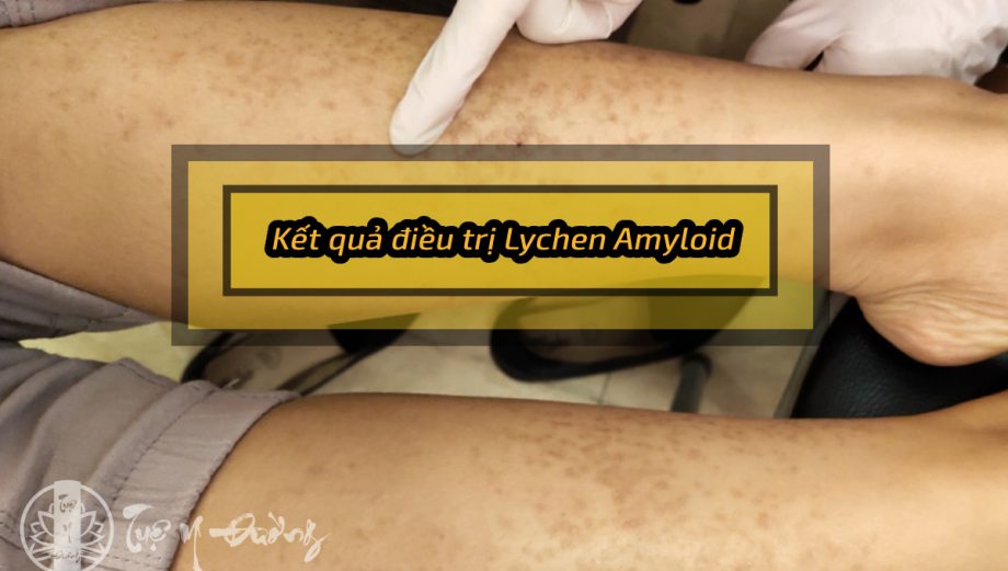 Lychen amyloid là một bệnh da liễu mạn tính do thoái hóa tinh bột lắng đọng ở da gây nên.