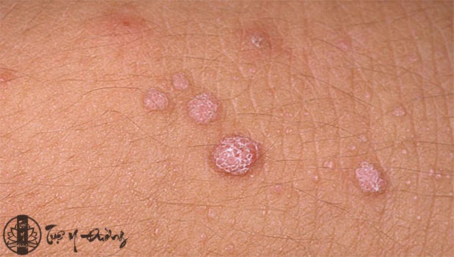 Virus HPV là nguyên nhân gây ra mụn cóc sinh dục
