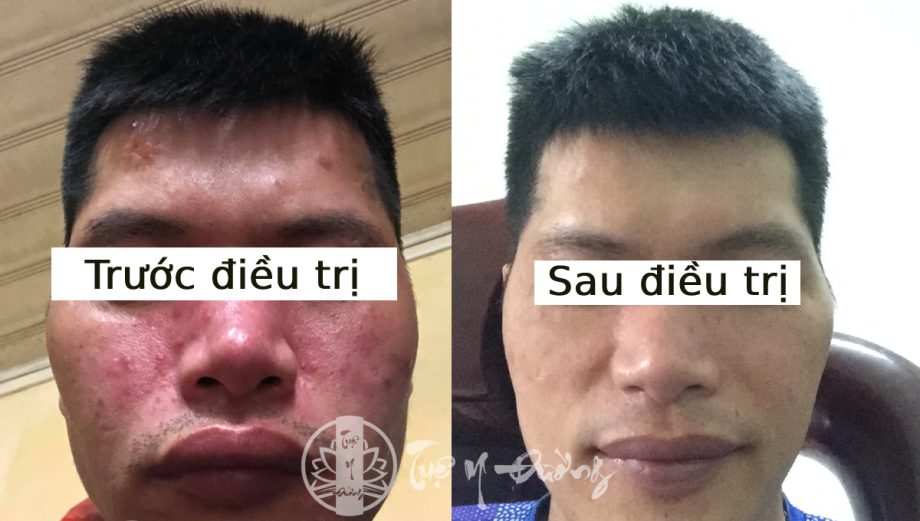 Ảnh trước và sau khi điều trị tại phòng khám Tuệ Y Đường
