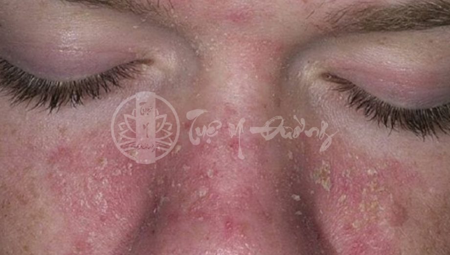 Viêm da tiết bã (seborrheic dermatitis) còn được gọi là bệnh chàm da mỡ hoặc viêm da dầu. 
