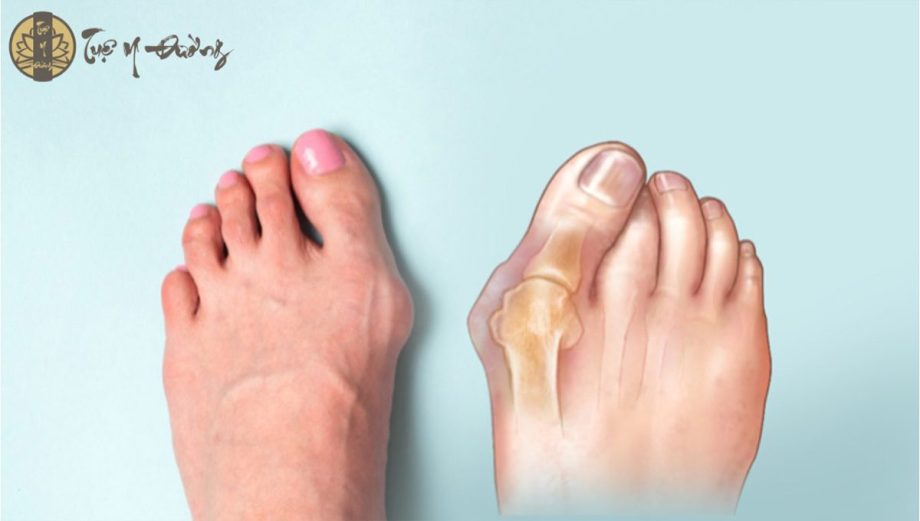Viêm khớp ngón chân cái gây đau, biến dạng ngón chân cái