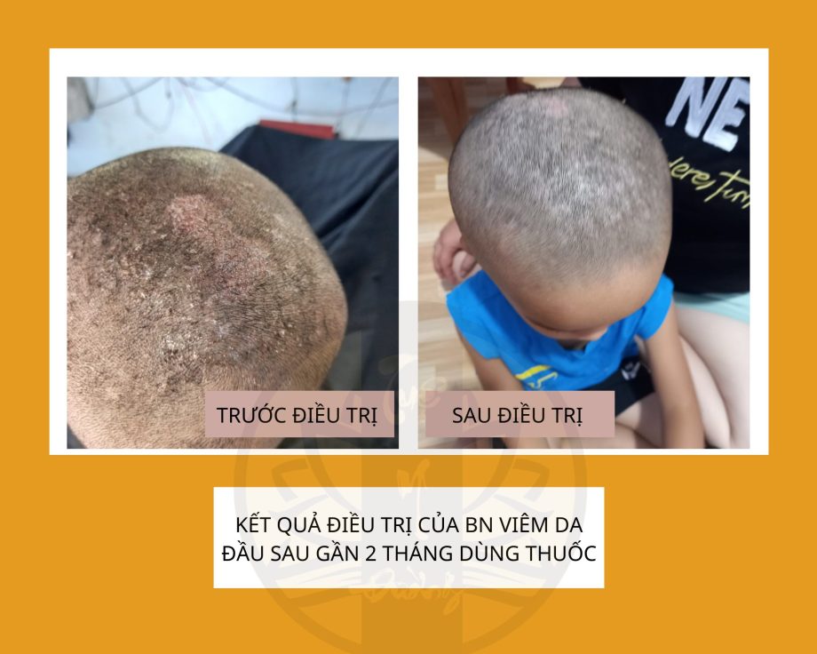 Hình ảnh da trước và sau khi điều trị bằng thuốc Đông y
