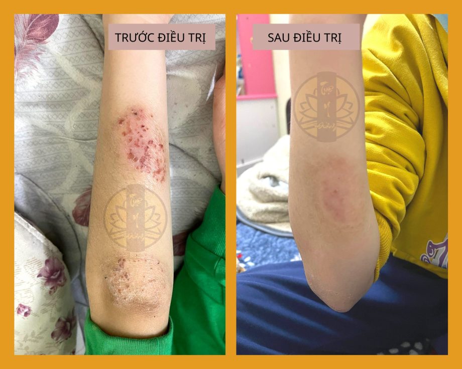 Hình ảnh tổn thương trước và sau điều trị của bệnh nhân Chàm vi khuẩn
