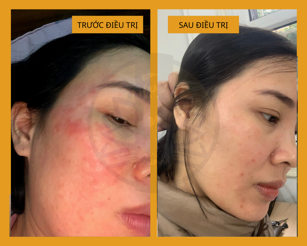 Hình ảnh trước và sau điều trị Viêm da dị ứng bằng Đông y