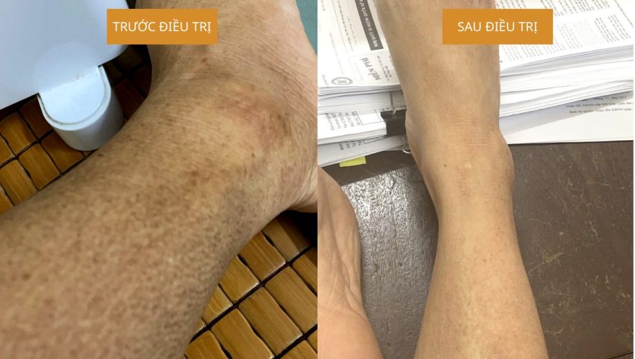 Ảnh trước và sau điều trị của bệnh nhân Lichen điều trị tại Tuệ Y Đường