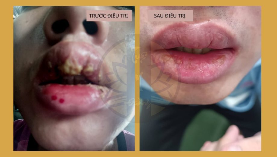 Hình ảnh tổn thương trước và sau điều trị Viêm da quanh miệng bằng Đông y