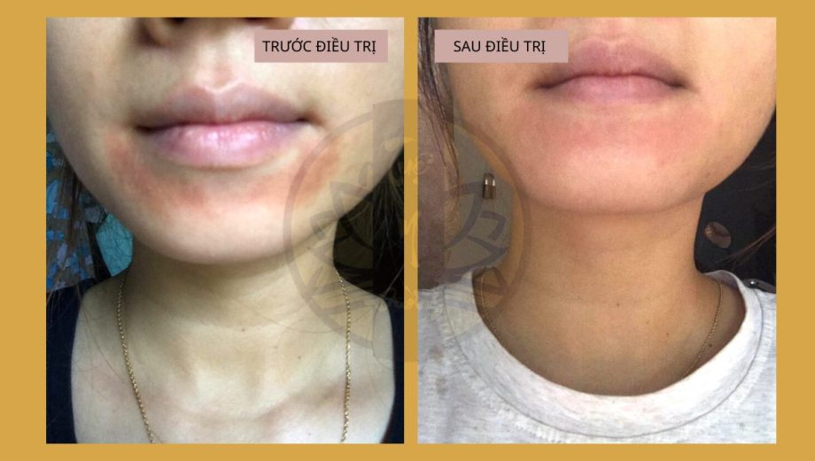Hình ảnh tổn thương trước và sau điều trị Viêm da quanh miệng bằng Đông y