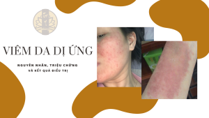 Kết quả điều trị viêm da dị ứng