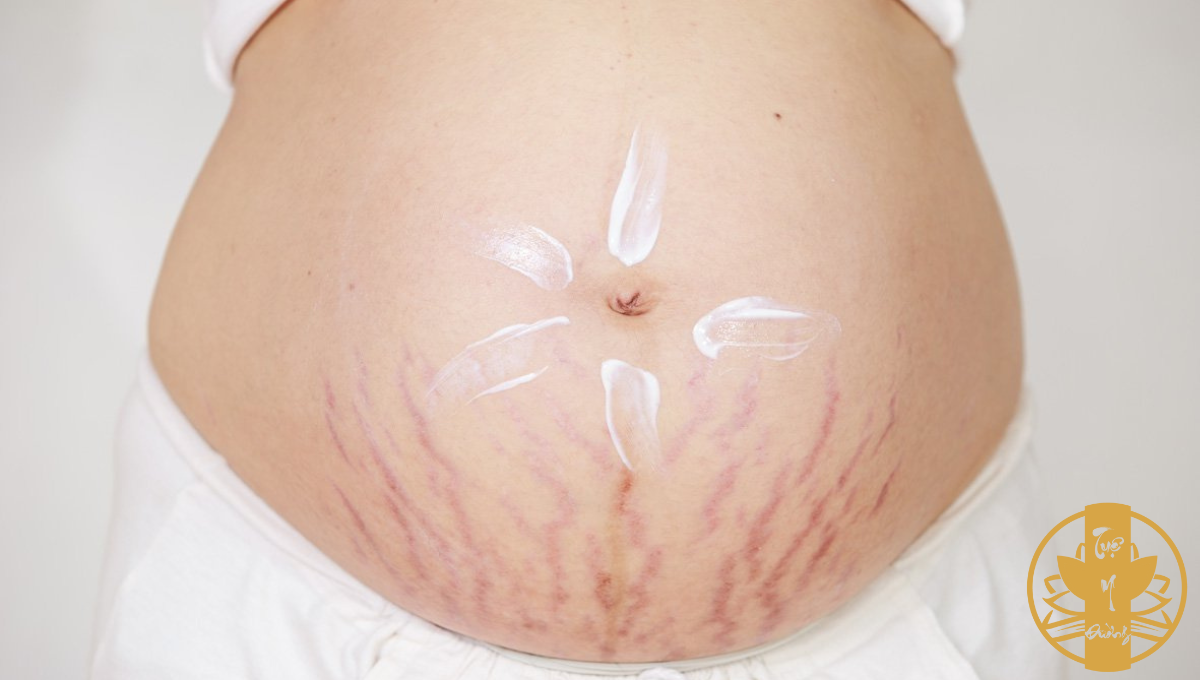 Thay đổi về da ở phụ nữ có thai