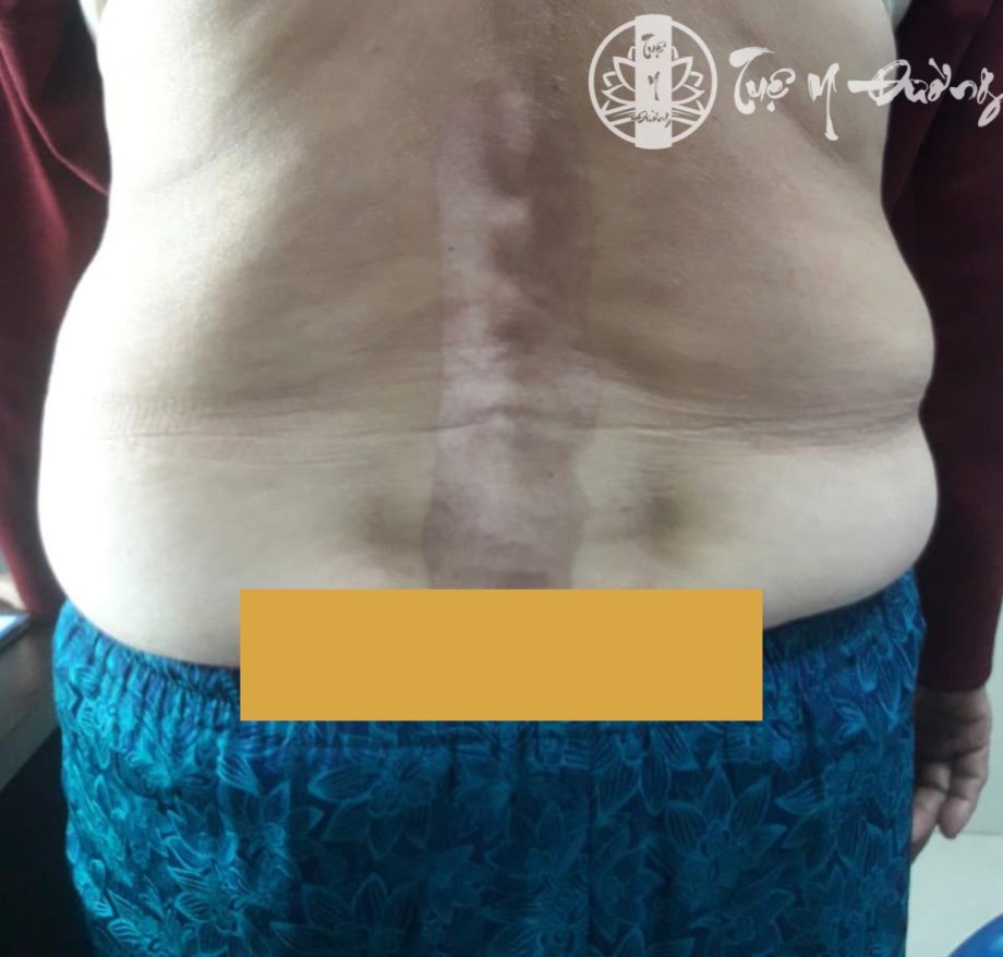 Hình ảnh bệnh nhân Gai cột sống điều trị đắp lá không uy tín gây bỏng vùng lưng