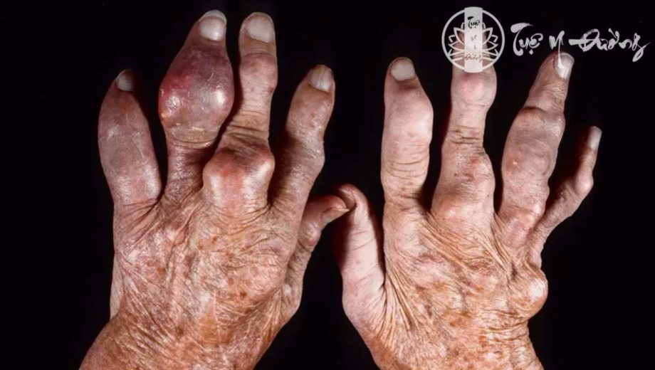Triệu chứng Gout ở bàn tay