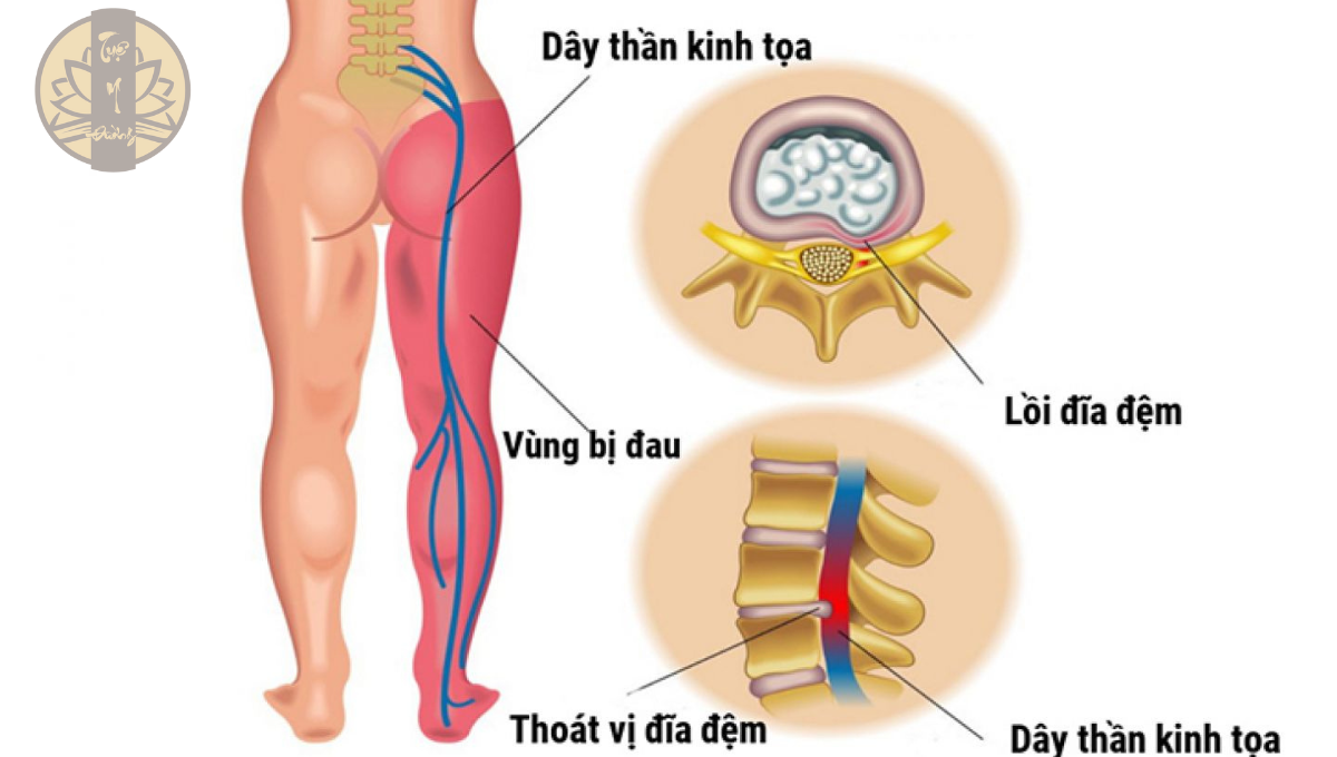 Hình ảnh đĩa đệm trong hội chứng thắt lưng hông do thoát vị đĩa đệm
