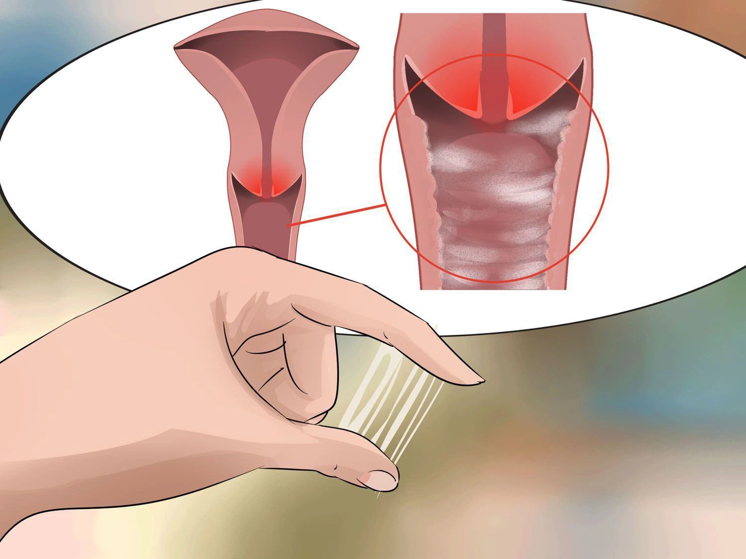 Hình ảnh khí hư trong bệnh lý viêm cổ tử cung