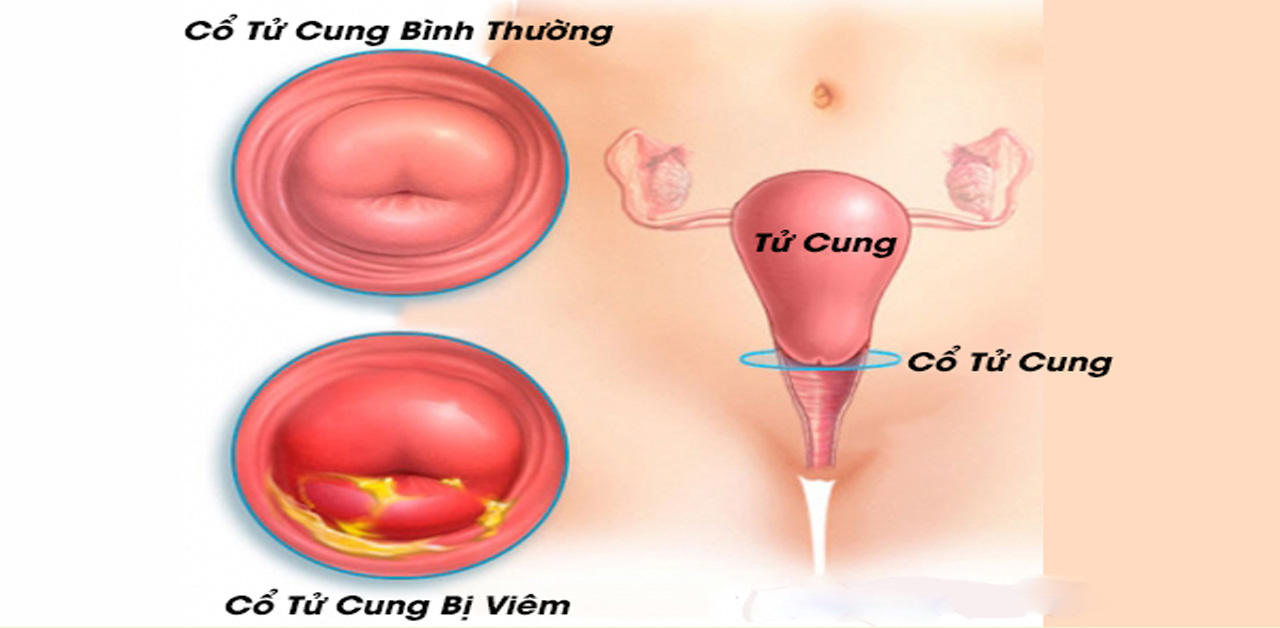 hình ảnh phân biệt giữa cổ tử cung bình thường và viêm cổ tử cung 