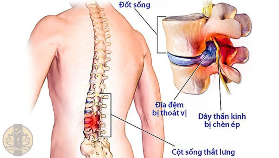 Thoát vị đĩa đệm là một trong những nguyên nhân gây đau thần kinh tọa