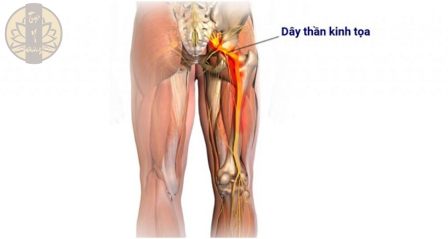 Dây thần kinh tọa bắt đầu từ cuối cột sống kéo dài đến các ngón chân