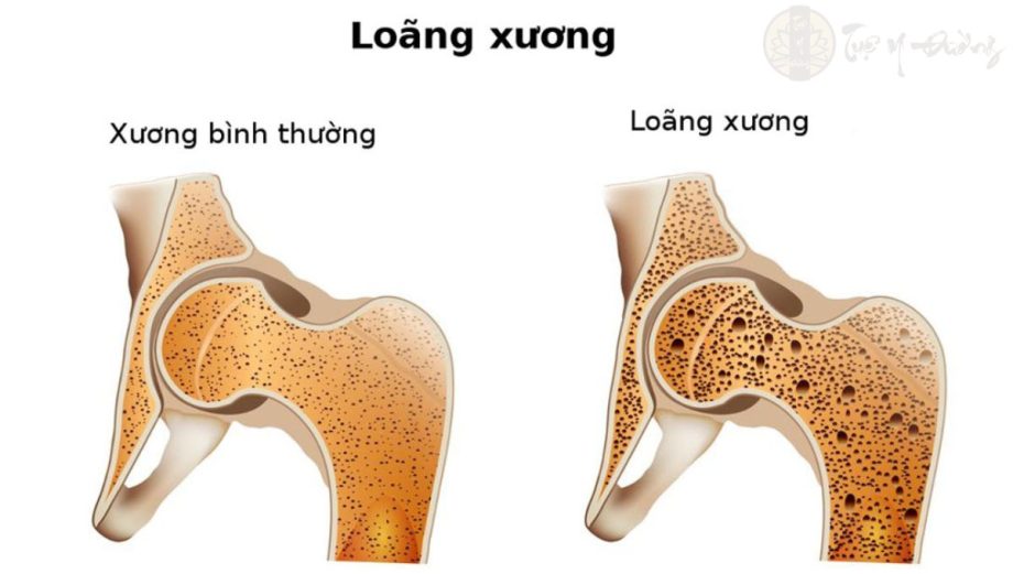 Dấu hiệu của loãng xương thường không rõ ràng