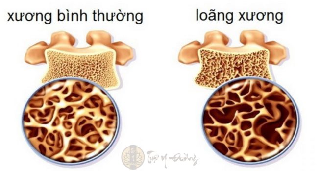 Loãng xương là tình trạng mật độ xương liên tục giảm làm cho xương trở nên giòn và dễ gãy