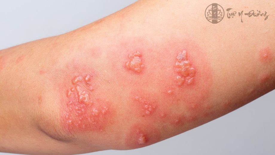 Biểu hiện trên da khi bị côn trùng độc cắn