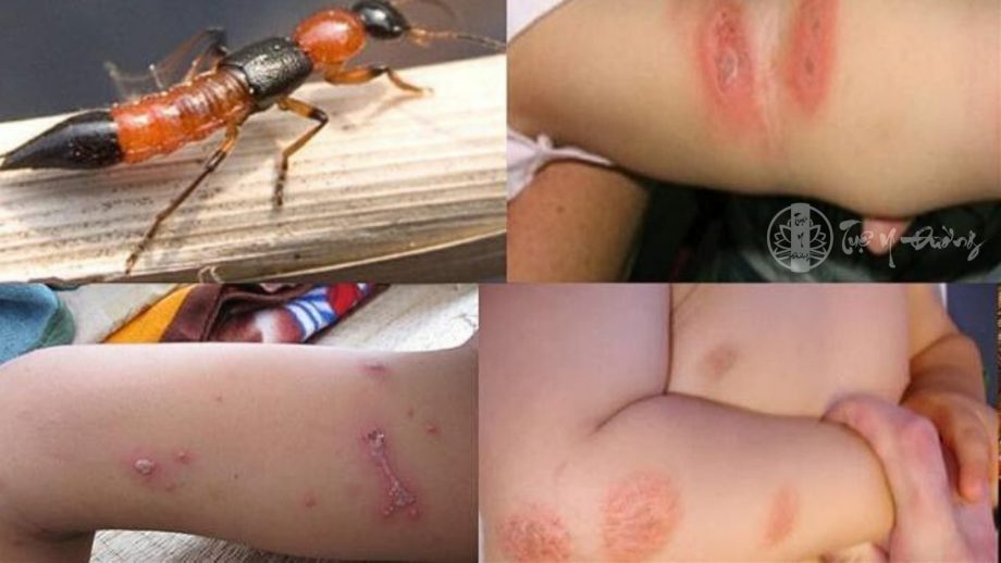 Bị côn trùng đốt là một trong những nguyên nhân gây viêm da sẩn ngứa