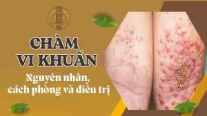 Chàm vi khuẩn, nguyên nhân, cách phòng và điều trị