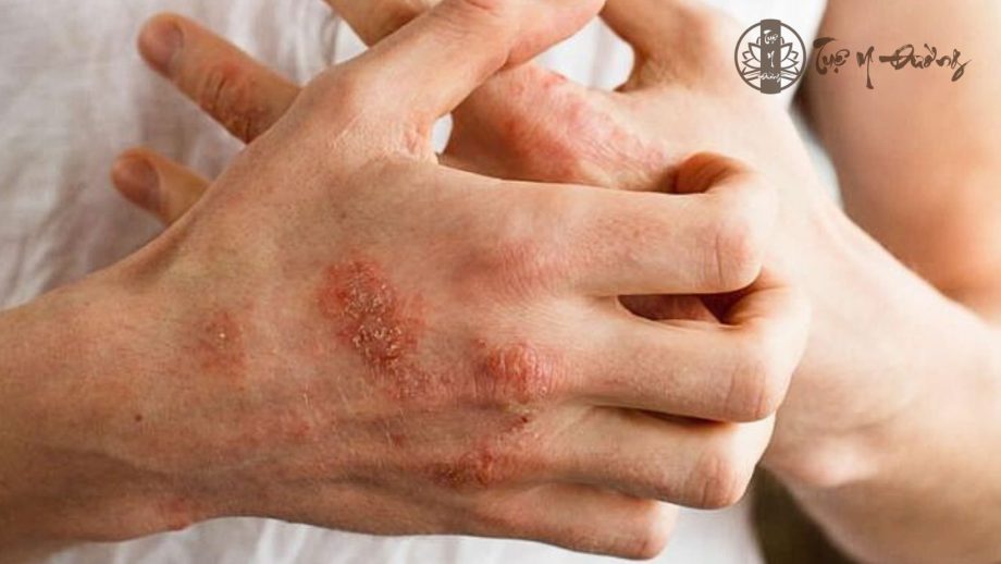 Thói quen này rất có hại cho làn da của bạn vì dễ khiến cho vùng da bị tổn thương trở nên dai dẳng hơn