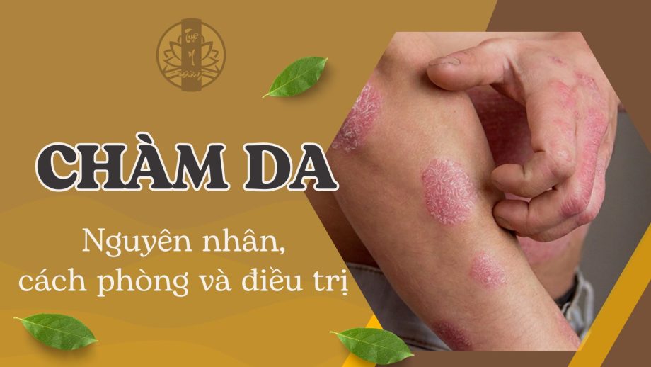 Chàm da, nguyên nhân cách phòng và điều trị